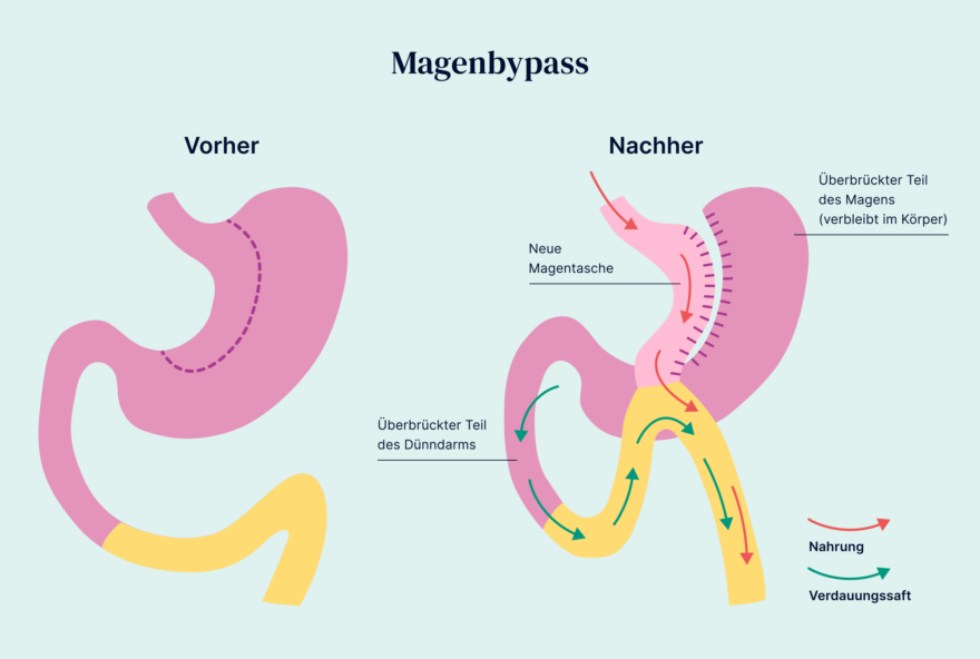Magenbypass bei Adipositas sinnvoll? Oviva Deutschland